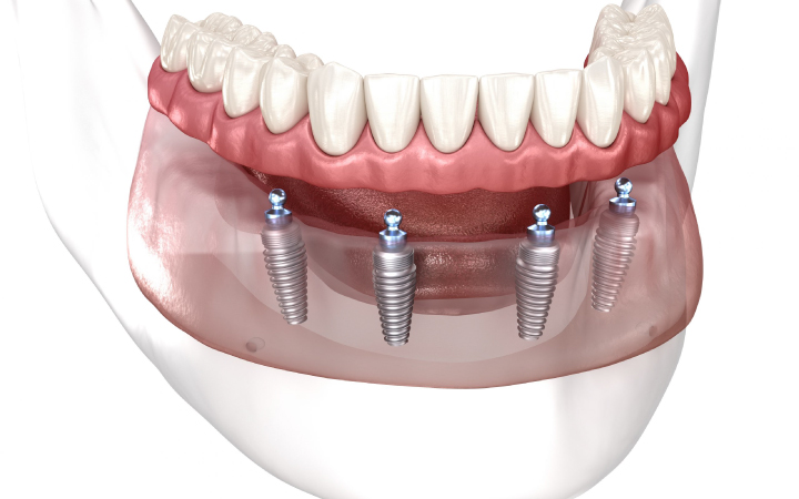 All-on-4 Implants