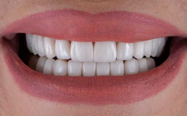 Composite veneers