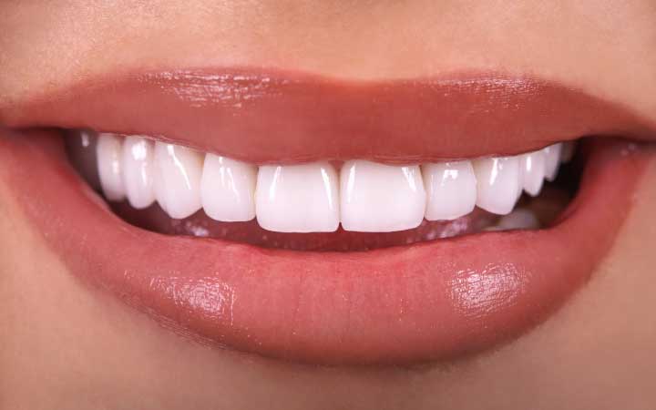 Porcelain veneers