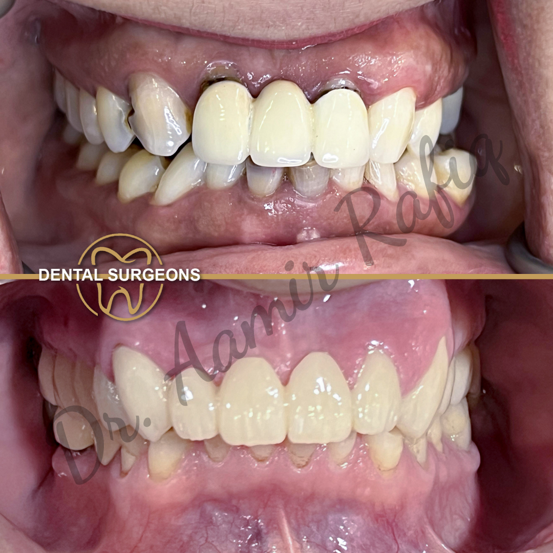 Zirconia Patient 4