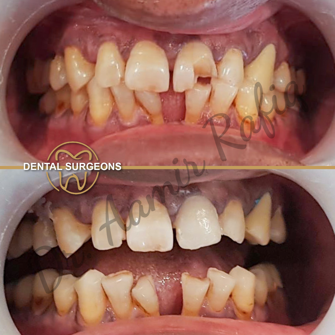 Zirconia Patient 3