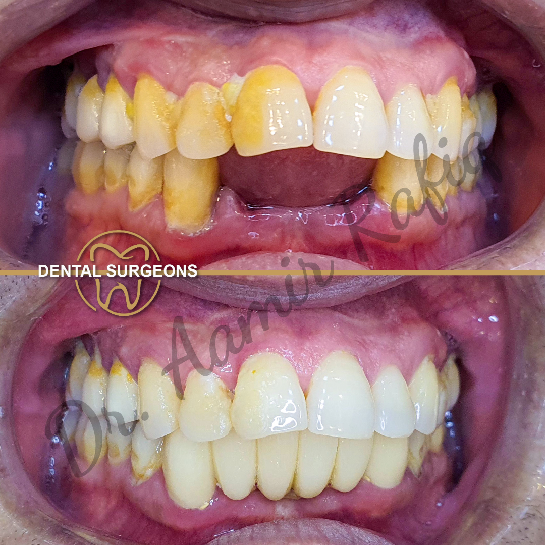 Zirconia Patient 5