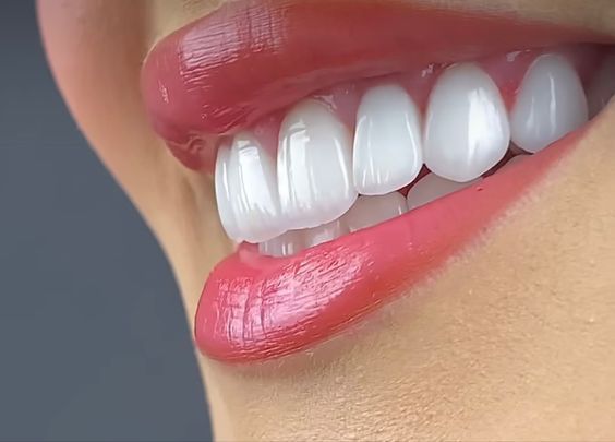 Teeth Whitening