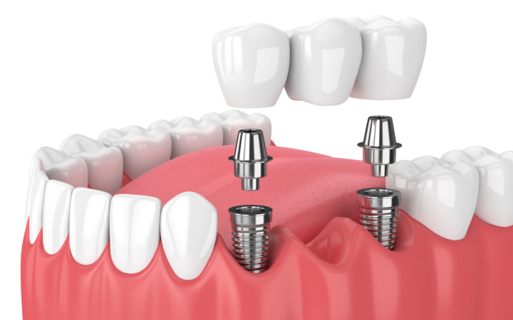 Implant Supported Bridge