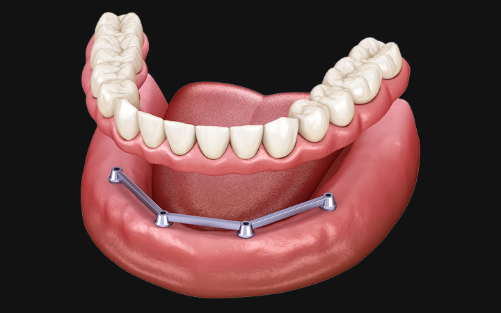 Implant Supported Dentures