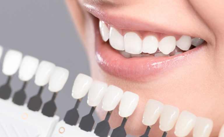 Dental Veneers at Dental Surgeons Gulberg Lahore