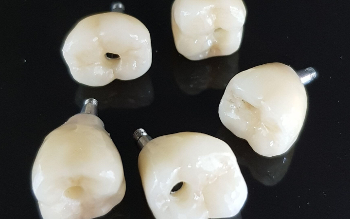 Screw-Retained Crown